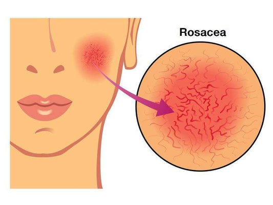 7 Tipps zur Hautpflege bei Rosacea | Beauty-Outlet24